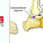 ankle sprains - Action Sports Clinic