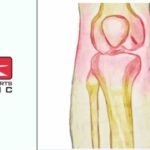 Osteoarthritis
