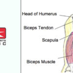 Action Sports - Bicep Tendinopathy