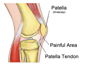 Patella Tendinopathy