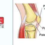 Patella Tendinopathy - Action Sports Clinic