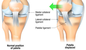 patella dislocation