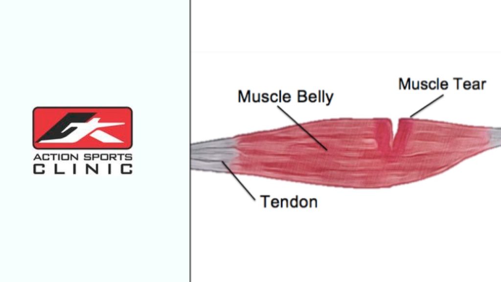 What Is Good For A Muscle Tear