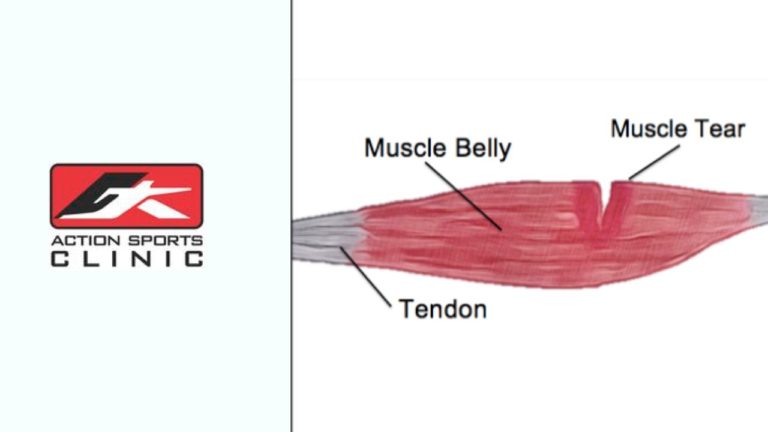 How Bad Is Muscle Tear