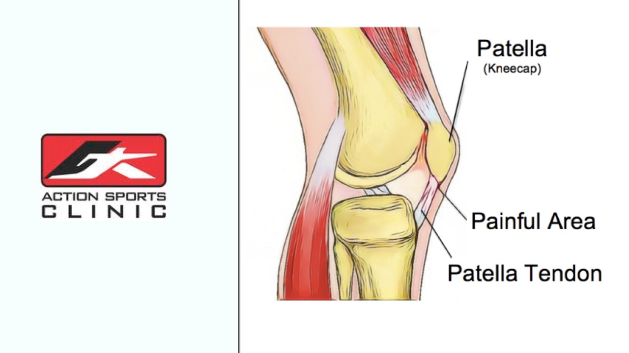 Patellar Tendinitis Chicago  Stem Cell Platelet Rich Plasma