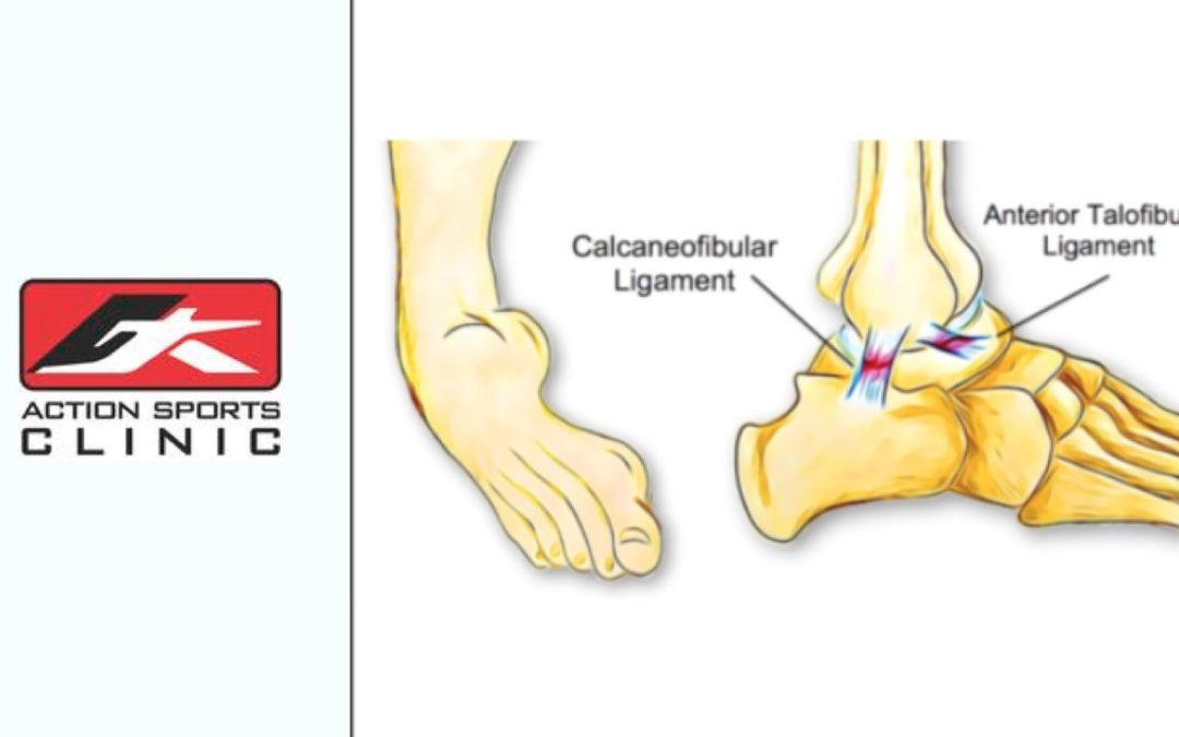 Chronic Ankle Instability