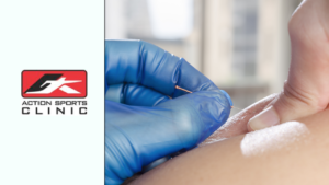 Intramuscular Stimulation Feature Image