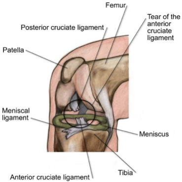 Physio Calgary - ACL Injury