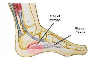 Plantar Fasciitis