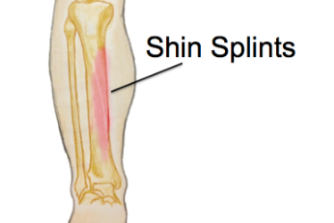 Common Running Injuries